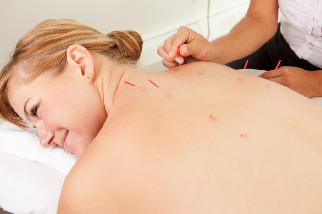 needling Acupuncture treatment Acupuncture